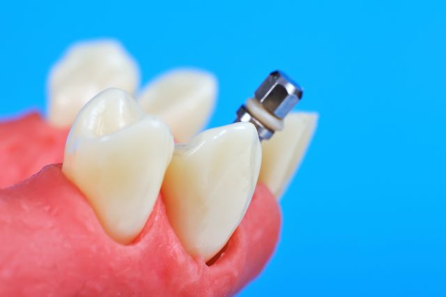 navigating-the-path-to-a-restored-smile-a-comprehensive-guide-to-dental-implants