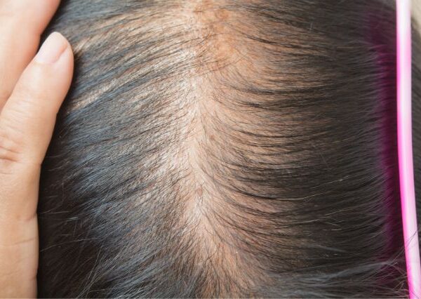 womens-hair-thinning-identifying-triggers-and-effective-solutions